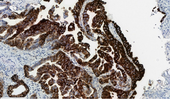 Pérdida citoplasmática debido a fijación incorrecta