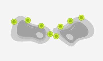 CLDN18.2 expuesta debido a alteraciones de la polaridad celular y pérdida de estructura